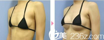 假體植入豐胸