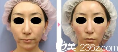 線雕提升術(shù)