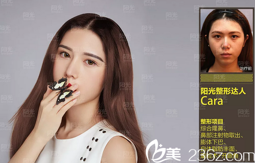 整形醫(yī)院隆鼻案例