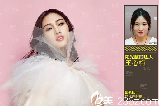 整形醫(yī)院雙眼皮案例