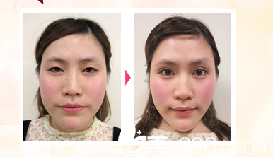 院長 雙眼皮手術(shù) 院長 雙眼皮手術(shù)