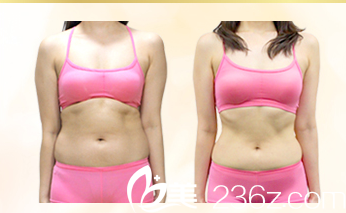 院長做吸脂手術(shù) 院長做吸脂手術(shù)