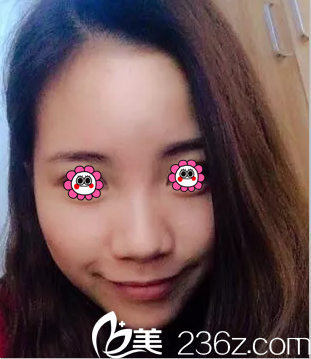 在北京櫻桃做隆鼻前樣子 在北京櫻桃做隆鼻前樣子