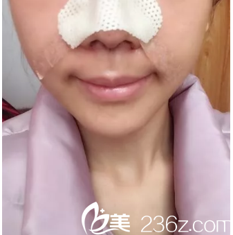 做隆鼻第3天樣子 做隆鼻第3天樣子