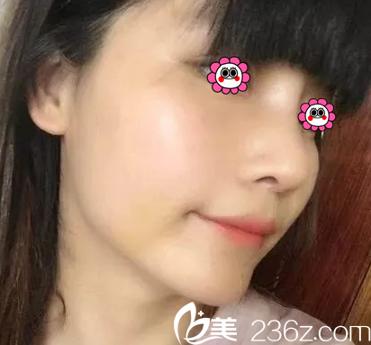 在北京櫻桃做肋軟骨鼻綜合第17天 在北京櫻桃做肋軟骨鼻綜合第17天