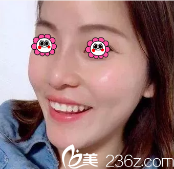 北京櫻桃肋軟骨鼻綜合隆鼻 北京櫻桃肋軟骨鼻綜合隆鼻