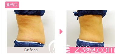 20181101_1541040589337126.png 吸脂2.png