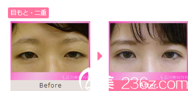 板井 雙眼皮 板井 雙眼皮