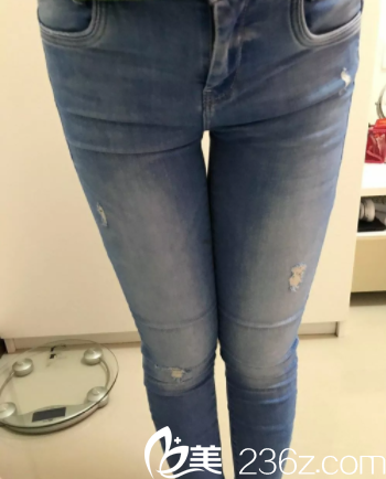 北京櫻桃腿部吸脂