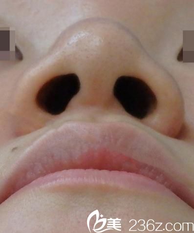 鼻翼縮小術(shù)前