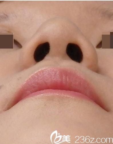 術(shù)后三個(gè)月