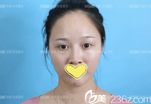 次做鼻整形失敗的我的術(shù)前照 次做鼻整形失敗的我的術(shù)前照