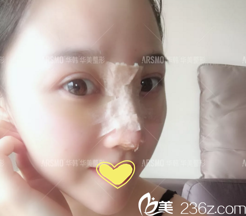 做鼻修復(fù)術(shù)后第3天<span style= 做鼻修復(fù)術(shù)后第3天<span style=