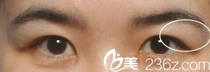 南陽(yáng)維多利亞整形改善腫泡眼