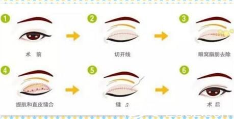 南陽(yáng)維多利亞整形全切雙眼皮改善腫泡眼