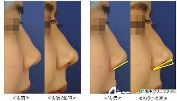 鼻中隔延長 鼻中隔延長