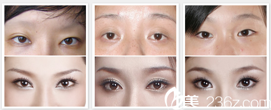 崔培培雙眼皮案例 崔培培雙眼皮案例