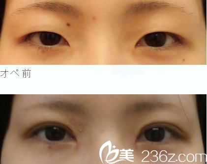 做手術(shù)1個月后效果 做手術(shù)1個月后效果