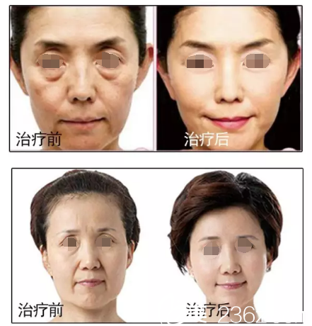 劉茜主任除皺案例 劉茜主任除皺案例