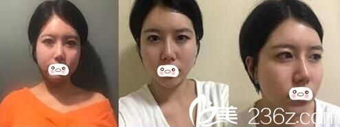 術前嚴重的大小眼 術前嚴重的大小眼