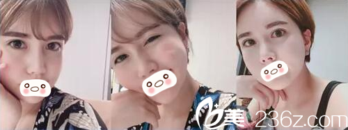 面部腫脹逐漸消退 面部腫脹逐漸消退