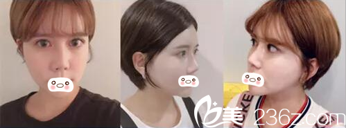 林鐘佑院長vline手術 + 七點埋線粘連法 + 納米脂肪移植 林鐘佑院長vline手術 + 七點埋線粘連法 + 納米脂肪移植