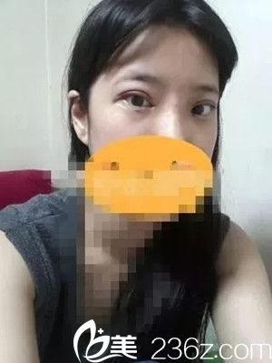 術后三天 術后三天