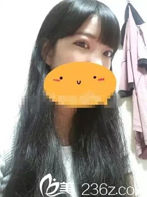 郭峰醫(yī)生雙眼皮手術案例 郭峰醫(yī)生雙眼皮手術案例