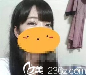 雙眼皮術后一個月 雙眼皮術后一個月