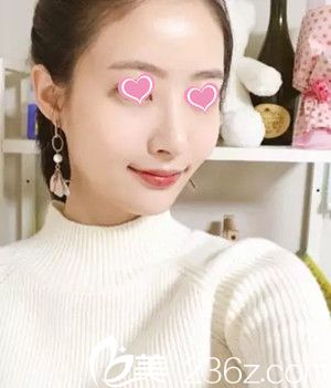 假體隆鼻后15天