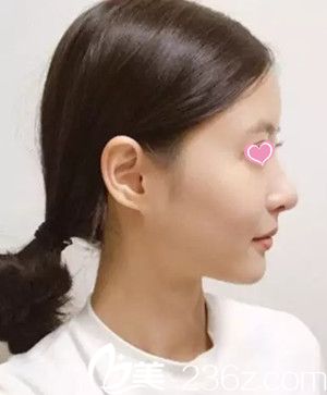 隆鼻后側(cè)面照