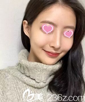 吉安天使整形醫(yī)院做隆鼻手術(shù)怎么樣？給大家分享下我手術(shù)一個月后的恢復(fù)效果