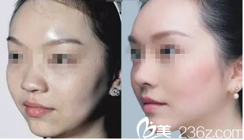 吳豫芳醫(yī)師微整形除皺案例