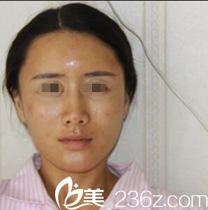 剛做完自體脂肪面部填充