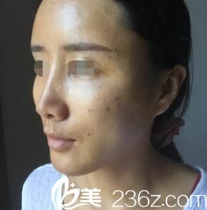 脂肪填充面部術(shù)后四天恢復(fù)