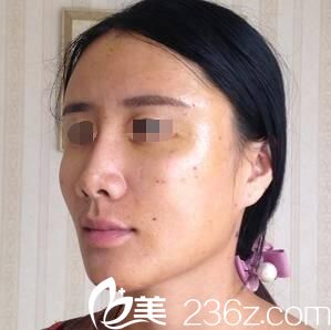 一周后自體脂肪面部填充恢復(fù)