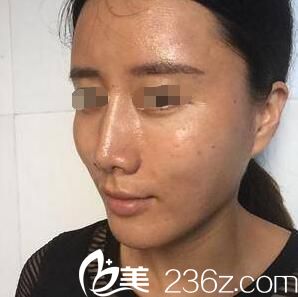 術(shù)后半個月自體脂肪恢復(fù)