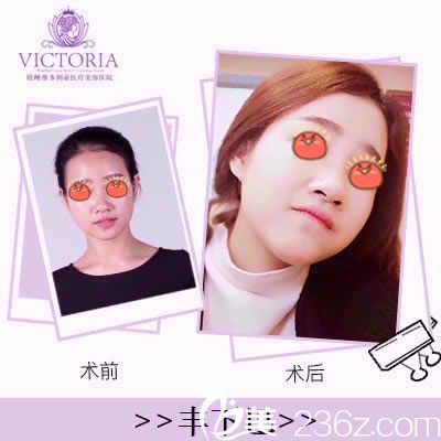 杭州維多利亞余英玻尿酸豐下巴案例