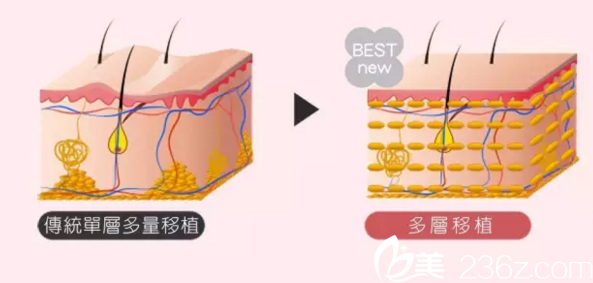 納米自體脂肪填充的優(yōu)勢(shì)