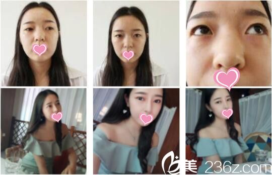 昆明夢想醫(yī)療美容醫(yī)院雙眼皮真人案例