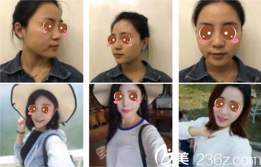 昆明夢想醫(yī)療美容醫(yī)院自體脂肪面部填充真人案例