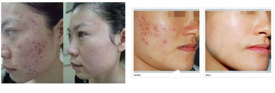 紅藍(lán)光祛痘前后對(duì)比案例 紅藍(lán)光祛痘前后對(duì)比案例