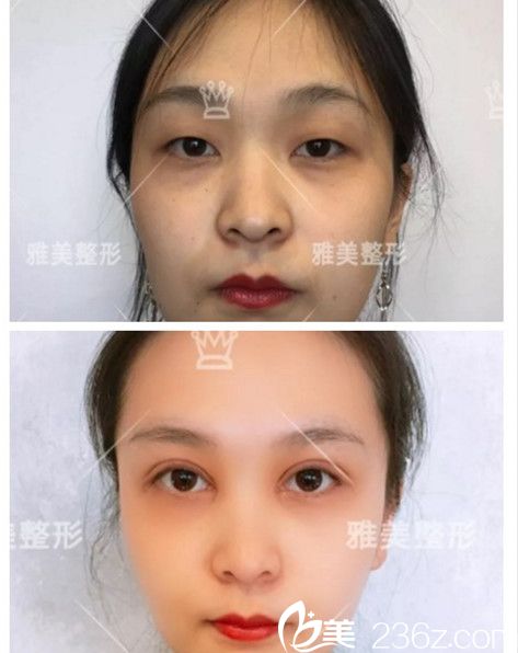 雅美切開(kāi)雙眼皮真人案例