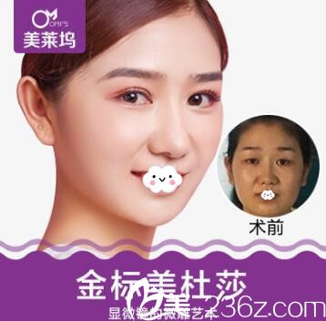 淮北東方美萊塢割雙眼皮術(shù)前術(shù)后真實效果對比