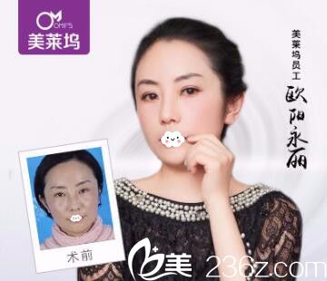 淮北東方美萊塢注射瘦臉除皺瘦臉真人案例效果圖