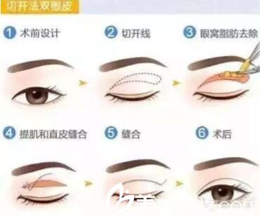 昆明韓辰醫(yī)療美容醫(yī)院切開法雙眼皮 昆明韓辰醫(yī)療美容醫(yī)院切開法雙眼皮