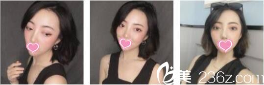 昆明韓辰醫(yī)療美容醫(yī)院王德寧全切雙眼皮真人案例術(shù)后兩個月 昆明韓辰醫(yī)療美容醫(yī)院王德寧全切雙眼皮真人案例術(shù)后兩個月