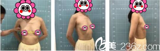 昆明韓辰醫(yī)療美容醫(yī)院陳寧自體脂肪隆胸真人案例術(shù)前照 昆明韓辰醫(yī)療美容醫(yī)院陳寧自體脂肪隆胸真人案例術(shù)前照