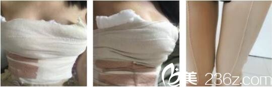 昆明韓辰醫(yī)療美容醫(yī)院陳寧自體脂肪隆胸真人案例術(shù)后第三天 昆明韓辰醫(yī)療美容醫(yī)院陳寧自體脂肪隆胸真人案例術(shù)后第三天