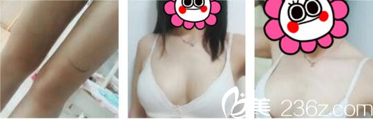 昆明韓辰醫(yī)療美容醫(yī)院陳寧自體脂肪隆胸真人案例術(shù)后第七天 昆明韓辰醫(yī)療美容醫(yī)院陳寧自體脂肪隆胸真人案例術(shù)后第七天